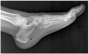 Rx lateral pie osteon