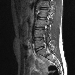 resonancia magnetica lumbar osteon alaquas valencia