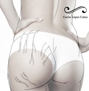 nervios cluneales carlos lopez cubas osteon