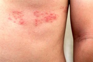 herpes zoster dolor neuropatico neuralgia postherpetica osteon neurodinamica