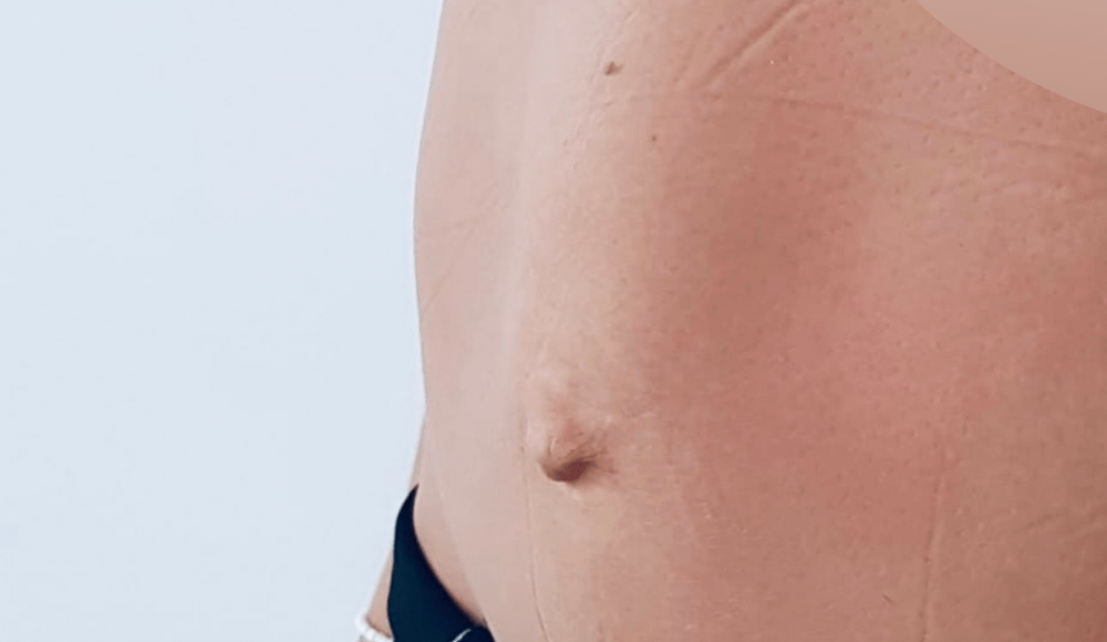 Diástasis abdominal postparto