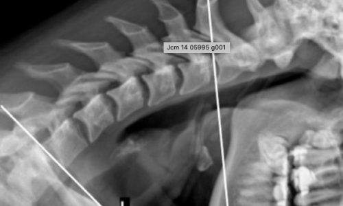 Biomecánica Cervical y su relación con la dinámica del Sistema Nervioso Central