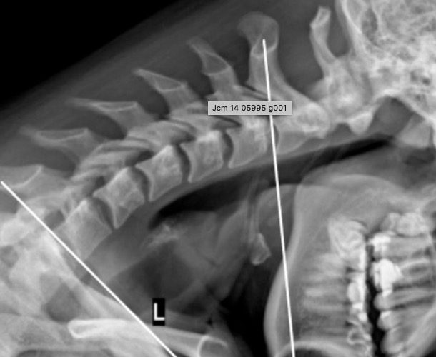 Biomecánica Cervical y su relación con la dinámica del Sistema Nervioso Central