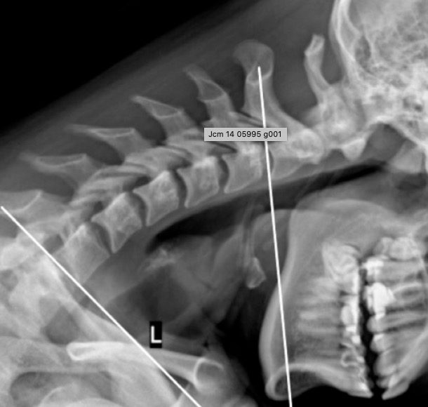 Biomecánica Cervical y su relación con la dinámica del Sistema Nervioso Central