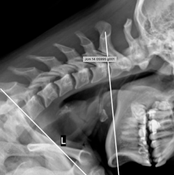 flexion cervical